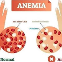 Anaemia: When something simple as iron deficiency can cause harm